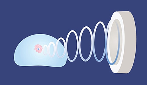 HIFU Focal Therapy For Prostate Cancer