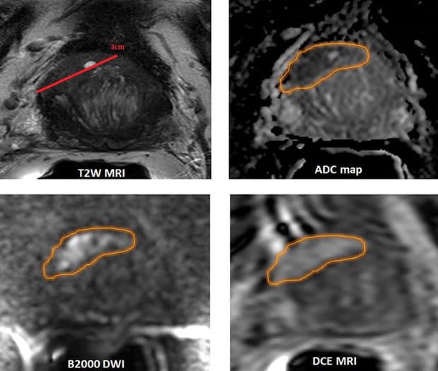 Prostate Cancer Imaging