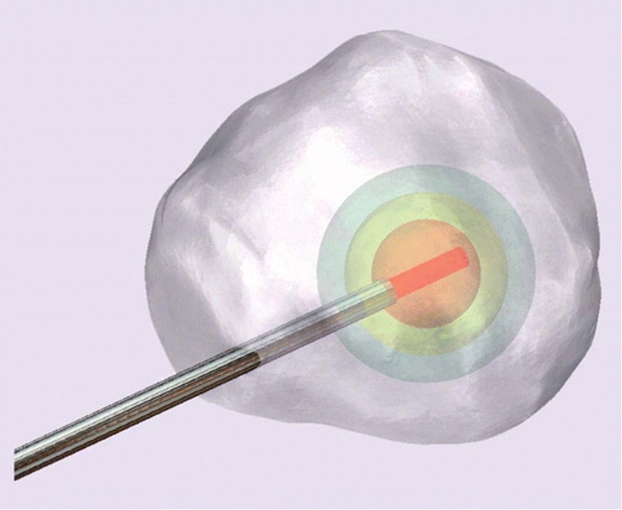 Focal Therapy- emerging strongly from the pandemic
