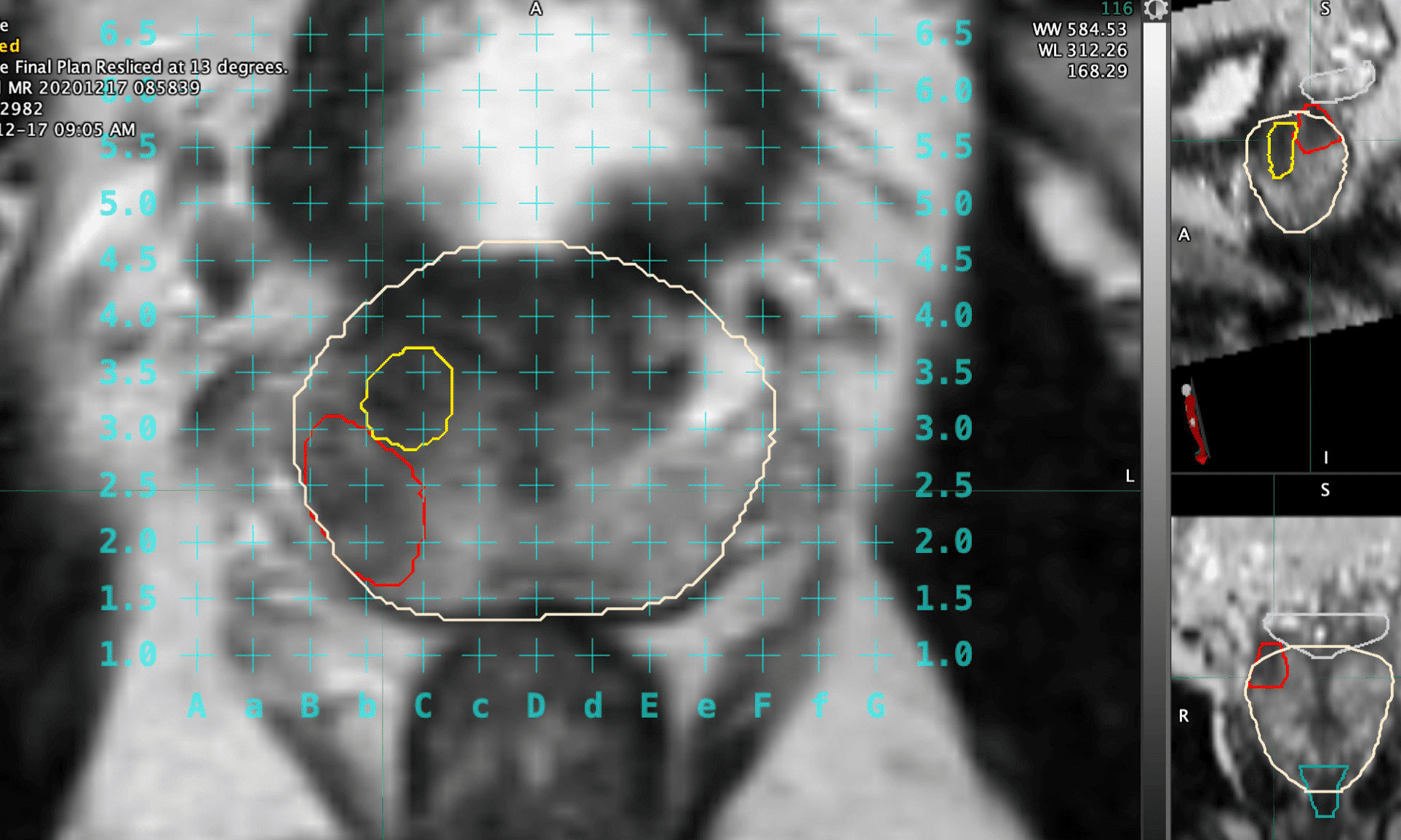 Prostate fusion biopsy plan contoured by Dr Clare Allen