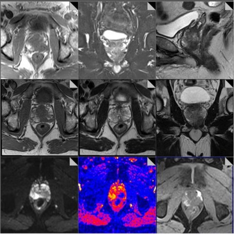 Mri
