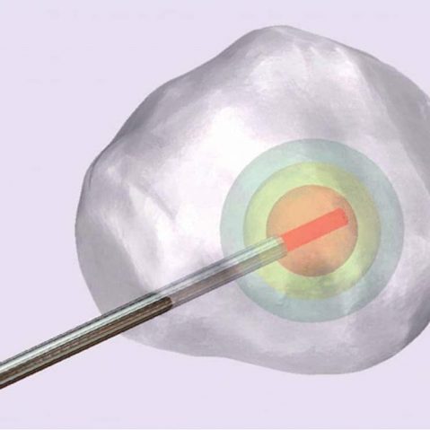 prostate biopsy diagram