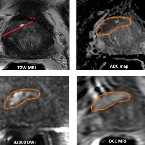 Prostate Cancer Imaging